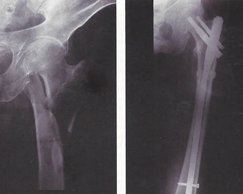 esiti-frattura-anca-femore-dr-giovanni-pignatti