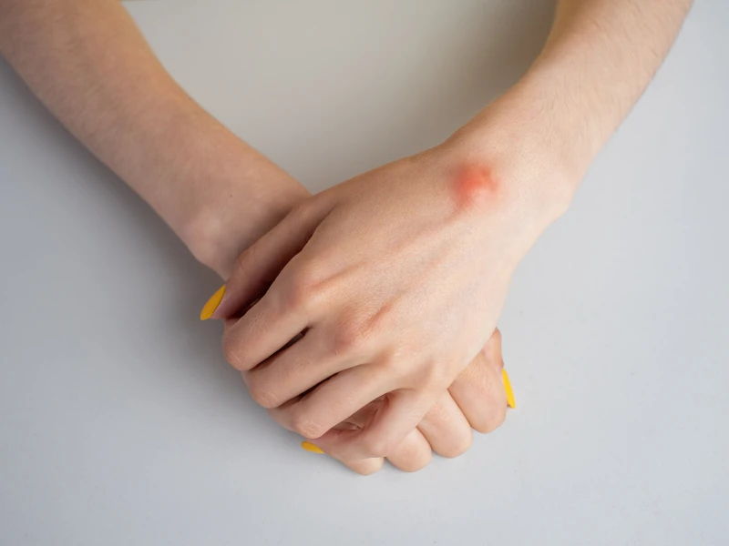 lipoma-dr-giovanni-pignatti